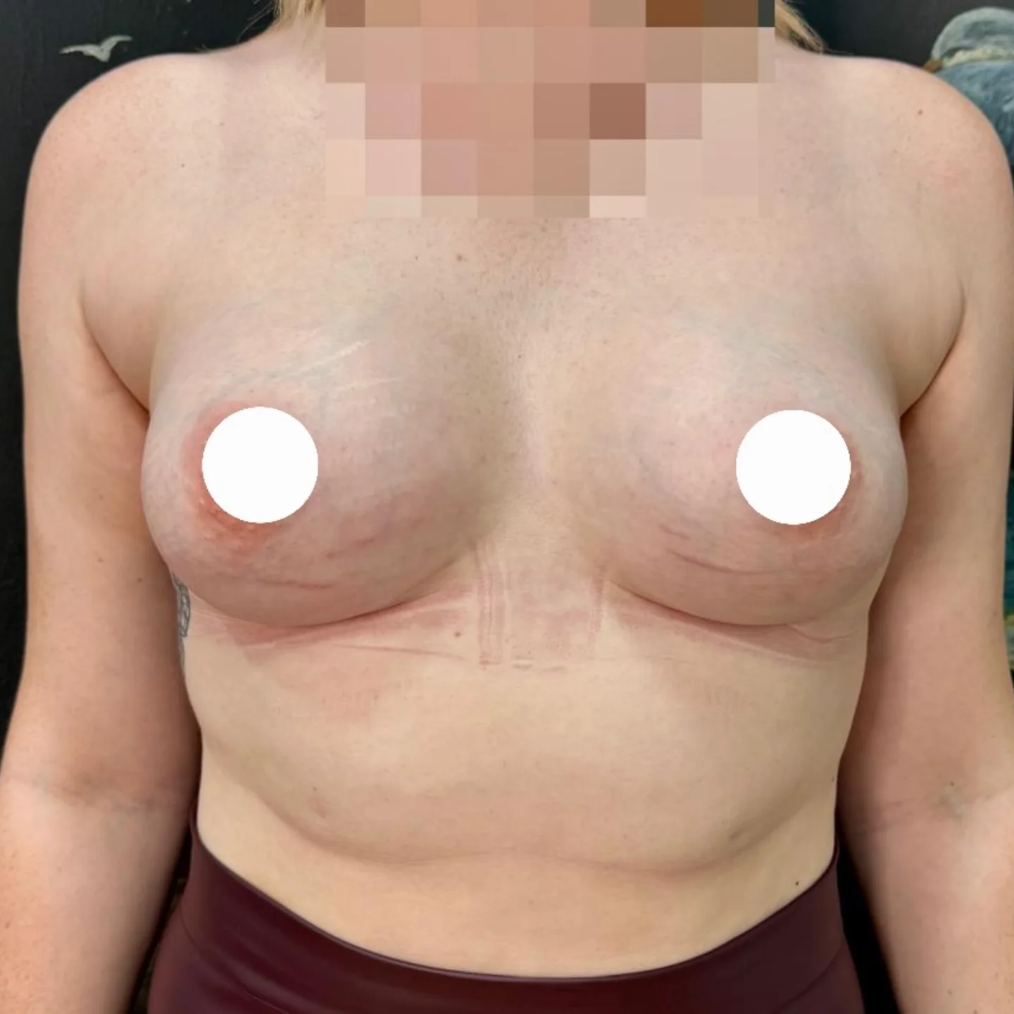 Breast Augmentation and Symmetry After